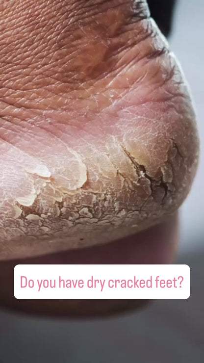 90 Minute Foot Renewal Mask – Exfoliating Foot Peel