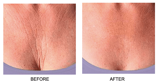 Skin Plumping Chest Wrinkle Reducer [Reusable Silicone Pad] - Dreambox Beauty