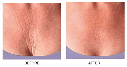 Skin Plumping Chest Wrinkle Reducer [Reusable Silicone Pad] - Dreambox Beauty