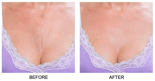 Skin Plumping Chest Wrinkle Reducer [Reusable Silicone Pad] - Dreambox Beauty