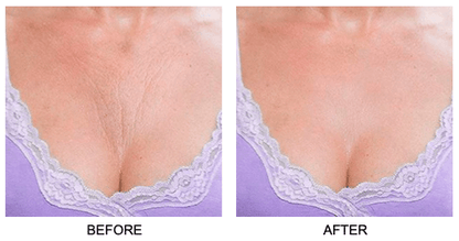 Skin Plumping Chest Wrinkle Reducer [Reusable Silicone Pad] - Dreambox Beauty